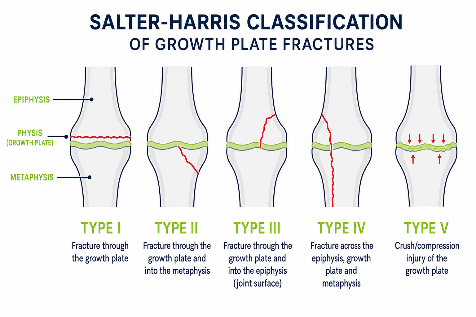 Diagram of the five Salter-Harris growth plate fracture types, each showing a child's bone end with the epiphysis, growth plate and metaphysis and the fracture line for types one to five